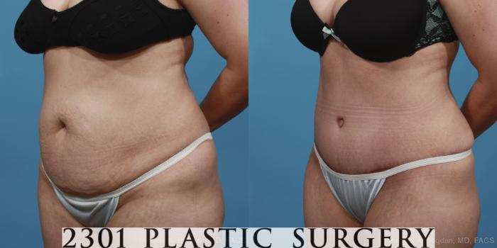 Before & After Tummy Tuck Case 369 View #3 View in Fort Worth, Plano, & Frisco, Texas