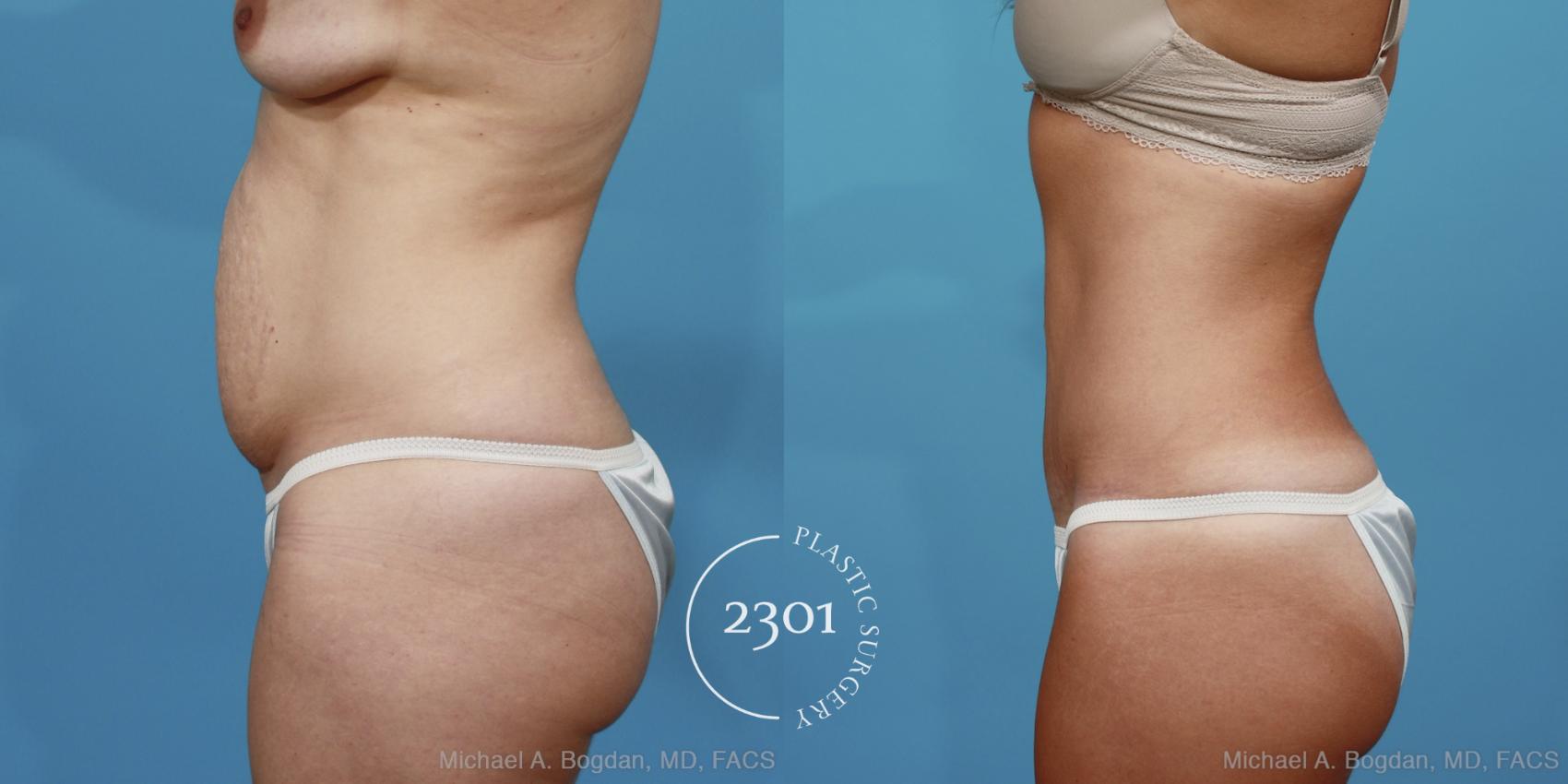 Before & After Tummy Tuck Case 370 View #2 View in Fort Worth, Plano, & Frisco, Texas