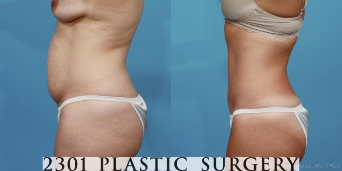 Before & After Tummy Tuck Case 370 View #2 View in Fort Worth, Plano, & Frisco, Texas