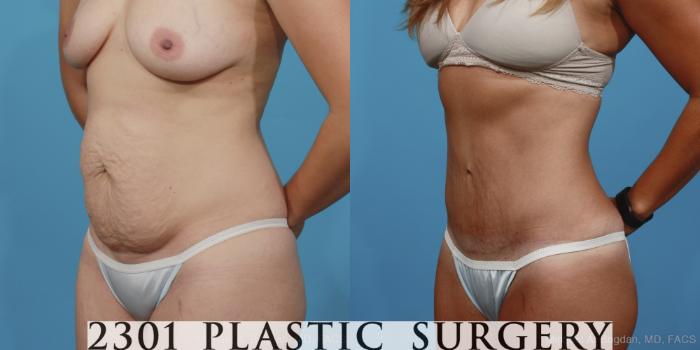 Before & After Tummy Tuck Case 370 View #3 View in Fort Worth, Plano, & Frisco, Texas