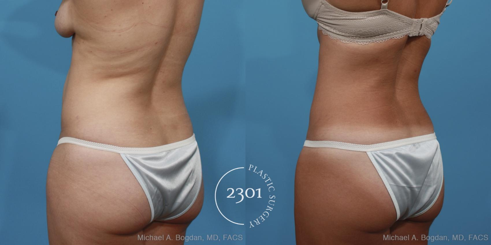 Before & After Tummy Tuck Case 370 View #4 View in Fort Worth, Plano, & Frisco, Texas