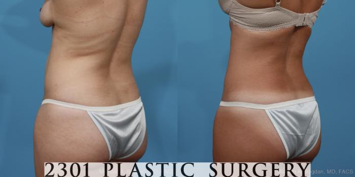 Before & After Tummy Tuck Case 370 View #4 View in Fort Worth, Plano, & Frisco, Texas