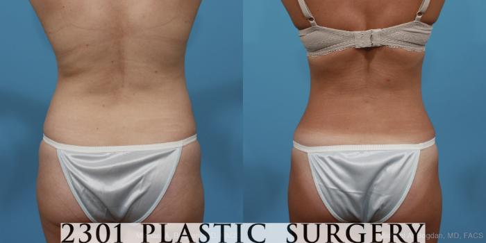 Before & After Tummy Tuck Case 370 View #5 View in Fort Worth, Plano, & Frisco, Texas