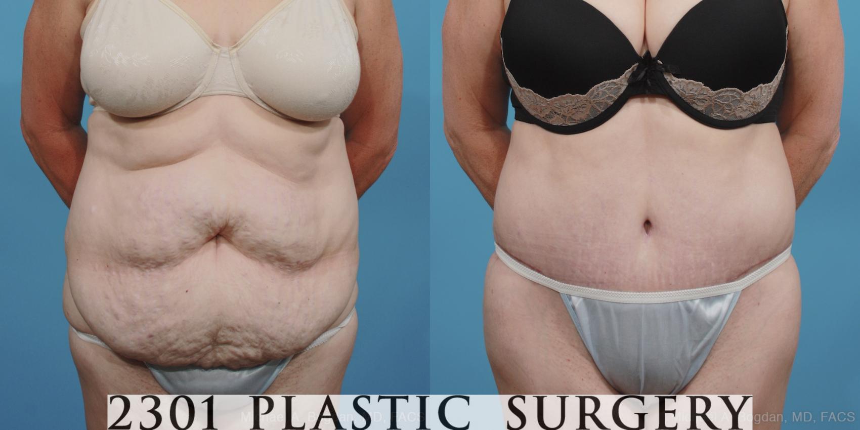 Before & After Tummy Tuck Case 396 View #1 View in Fort Worth, Plano, & Frisco, Texas