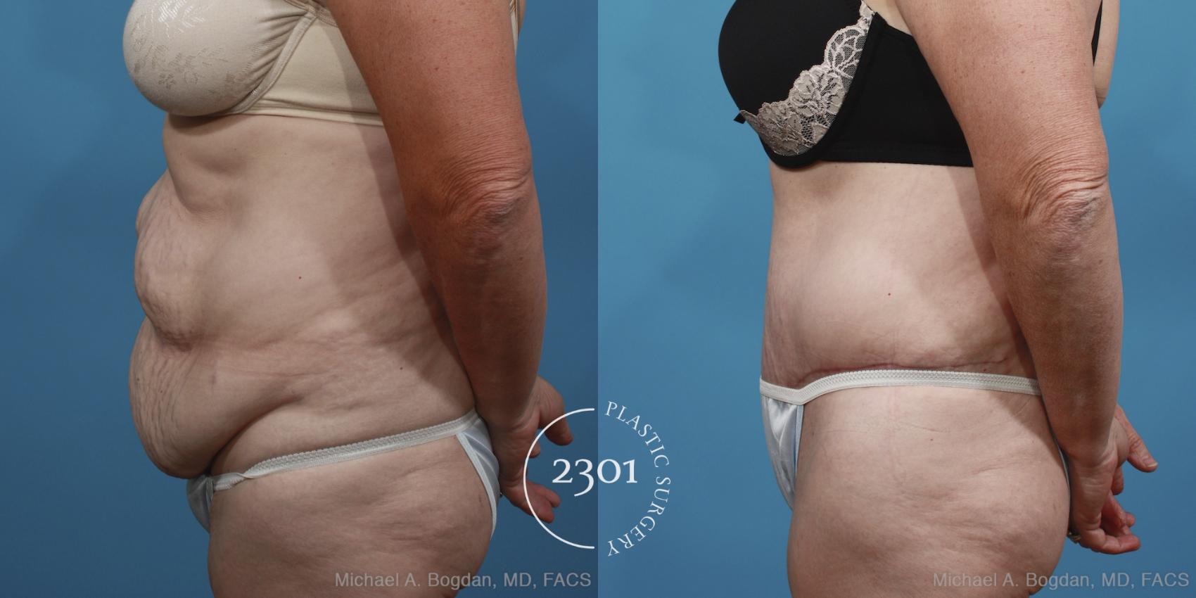Before & After Tummy Tuck Case 396 View #2 View in Fort Worth, Plano, & Frisco, Texas