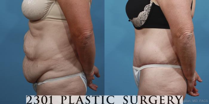 Before & After Tummy Tuck Case 396 View #2 View in Fort Worth, Plano, & Frisco, Texas