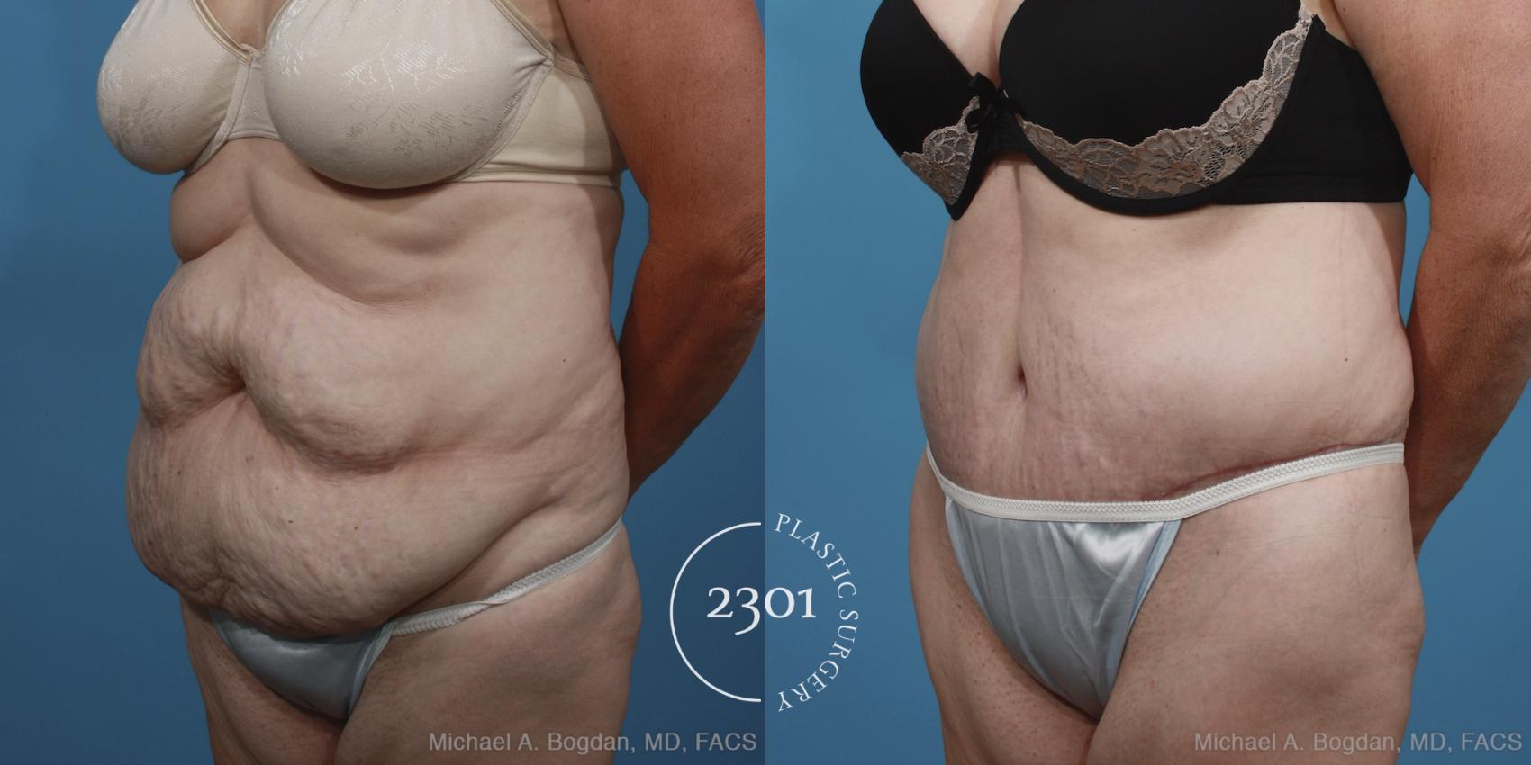 Before & After Tummy Tuck Case 396 View #3 View in Fort Worth, Plano, & Frisco, Texas