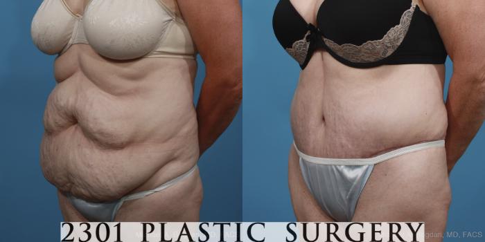 Before & After Tummy Tuck Case 396 View #3 View in Fort Worth, Plano, & Frisco, Texas
