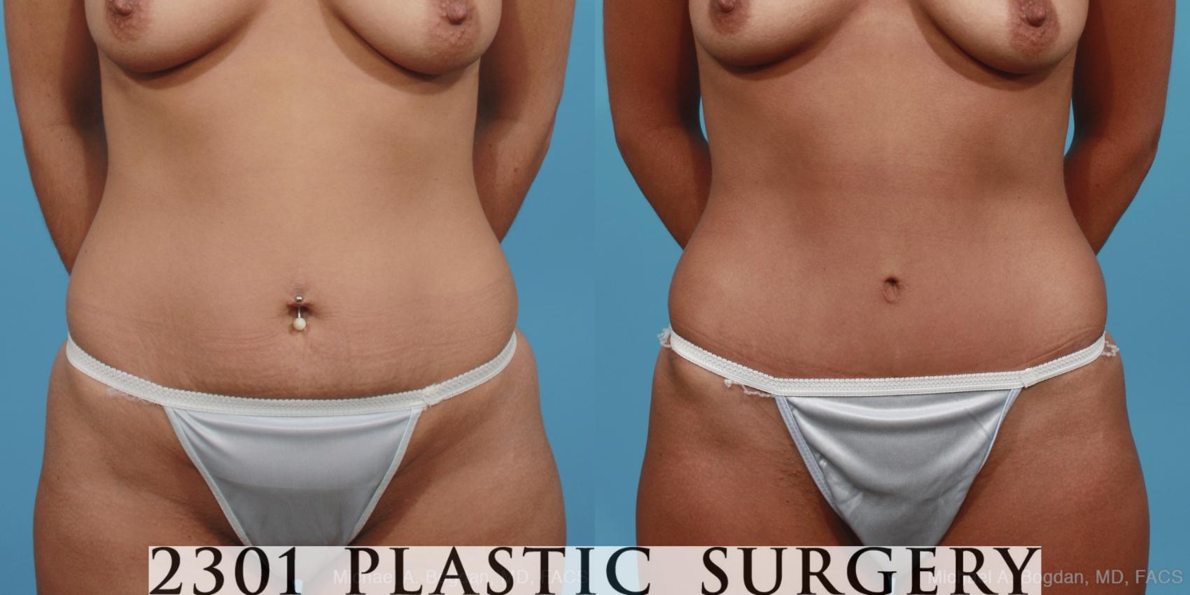 Before & After Tummy Tuck Case 402 View #1 View in Fort Worth, Plano, & Frisco, Texas