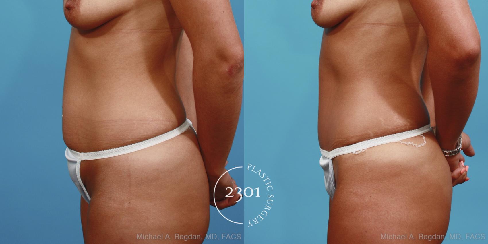 Before & After Tummy Tuck Case 402 View #2 View in Fort Worth, Plano, & Frisco, Texas