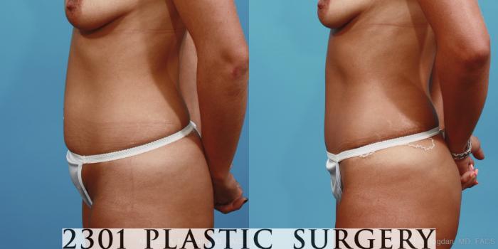 Before & After Tummy Tuck Case 402 View #2 View in Fort Worth, Plano, & Frisco, Texas