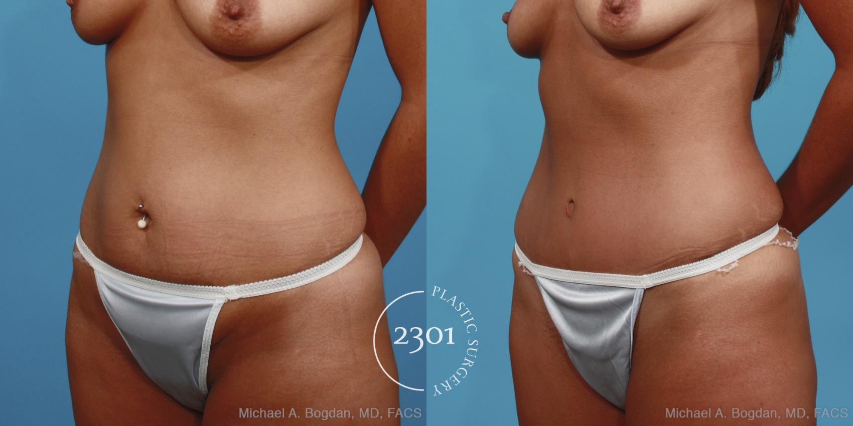 Before & After Tummy Tuck Case 402 View #3 View in Fort Worth, Plano, & Frisco, Texas