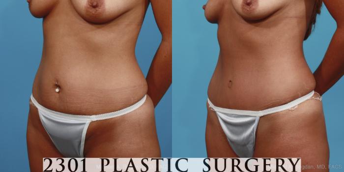 Before & After Tummy Tuck Case 402 View #3 View in Fort Worth, Plano, & Frisco, Texas