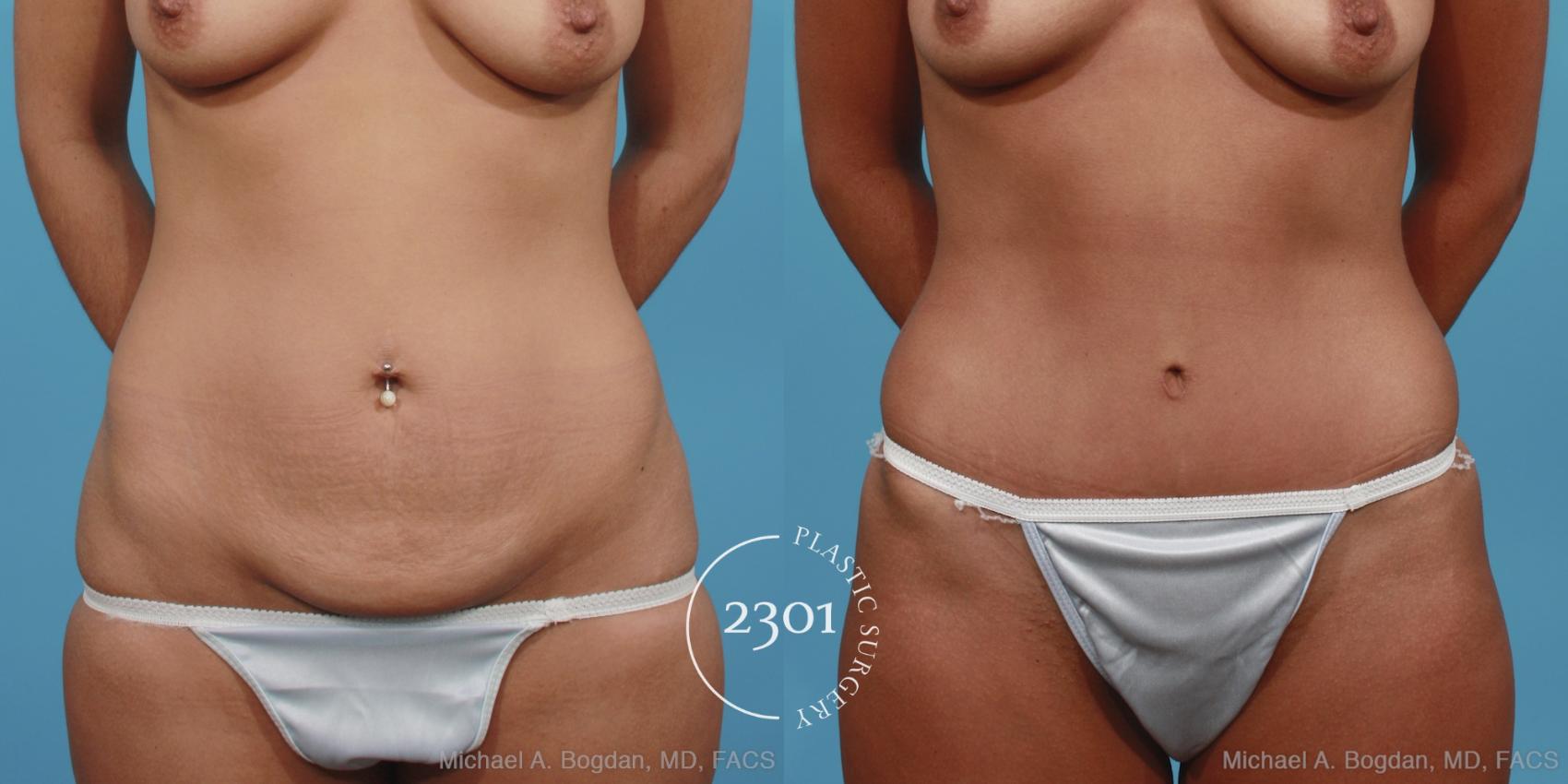 Before & After Tummy Tuck Case 402 View #4 View in Fort Worth, Plano, & Frisco, Texas