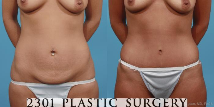 Before & After Tummy Tuck Case 402 View #4 View in Fort Worth, Plano, & Frisco, Texas