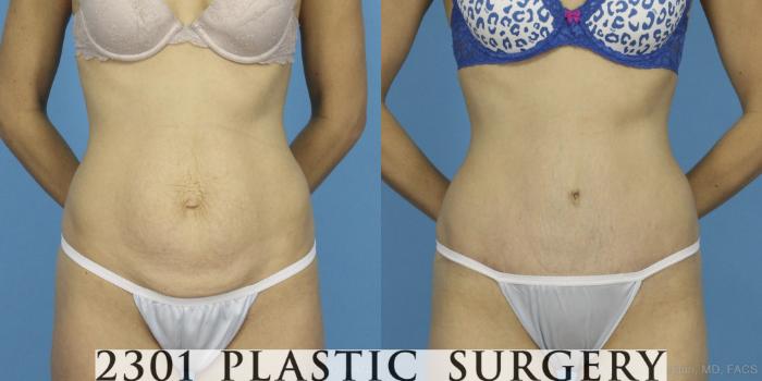 Before & After Tummy Tuck Case 405 View #1 View in Fort Worth, Plano, & Frisco, Texas
