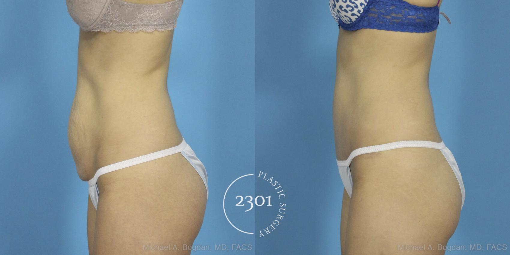 Before & After Tummy Tuck Case 405 View #2 View in Fort Worth, Plano, & Frisco, Texas