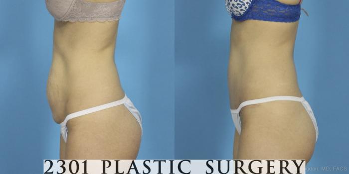 Before & After Tummy Tuck Case 405 View #2 View in Fort Worth, Plano, & Frisco, Texas