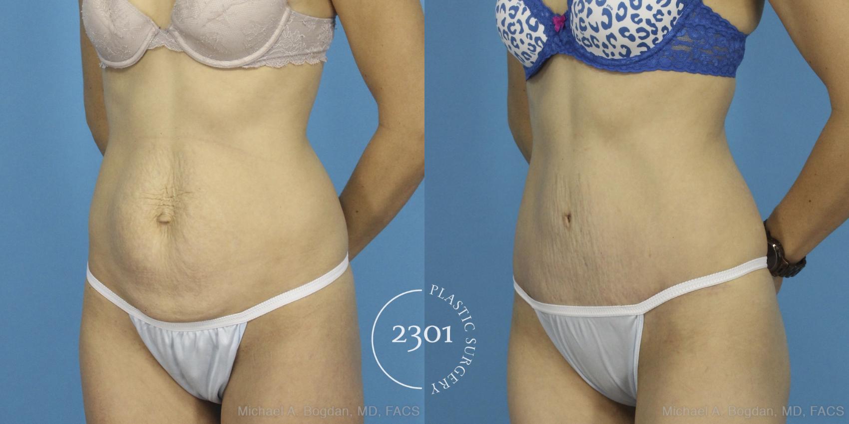 Before & After Tummy Tuck Case 405 View #3 View in Fort Worth, Plano, & Frisco, Texas