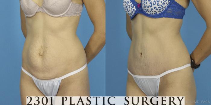 Before & After Tummy Tuck Case 405 View #3 View in Fort Worth, Plano, & Frisco, Texas