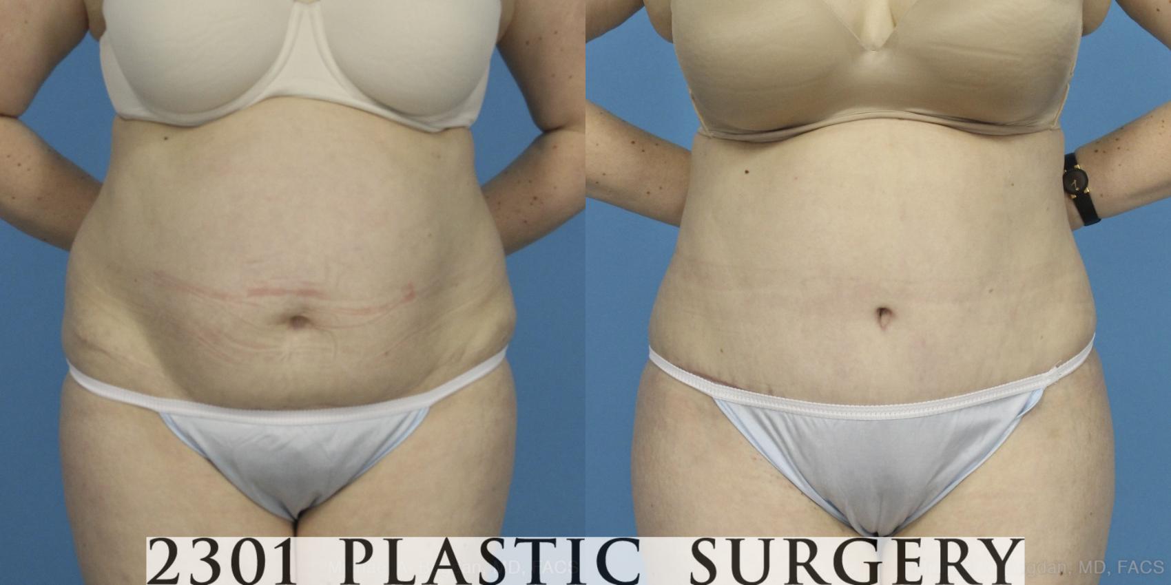 Before & After Tummy Tuck Case 407 View #1 View in Fort Worth, Plano, & Frisco, Texas