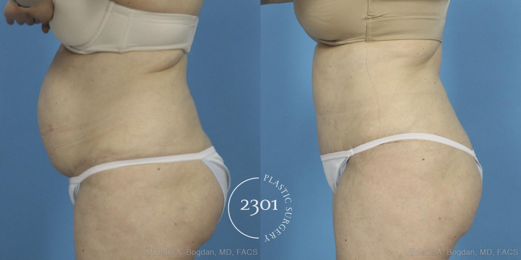 Before & After Liposuction Case 407 View #2 View in Fort Worth, Plano, & Frisco, Texas