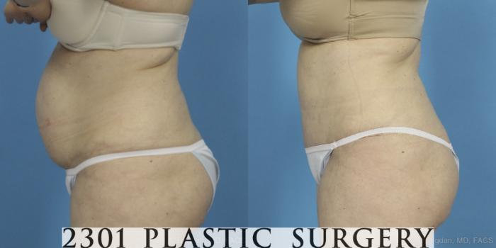 Before & After Tummy Tuck Case 407 View #2 View in Fort Worth, Plano, & Frisco, Texas
