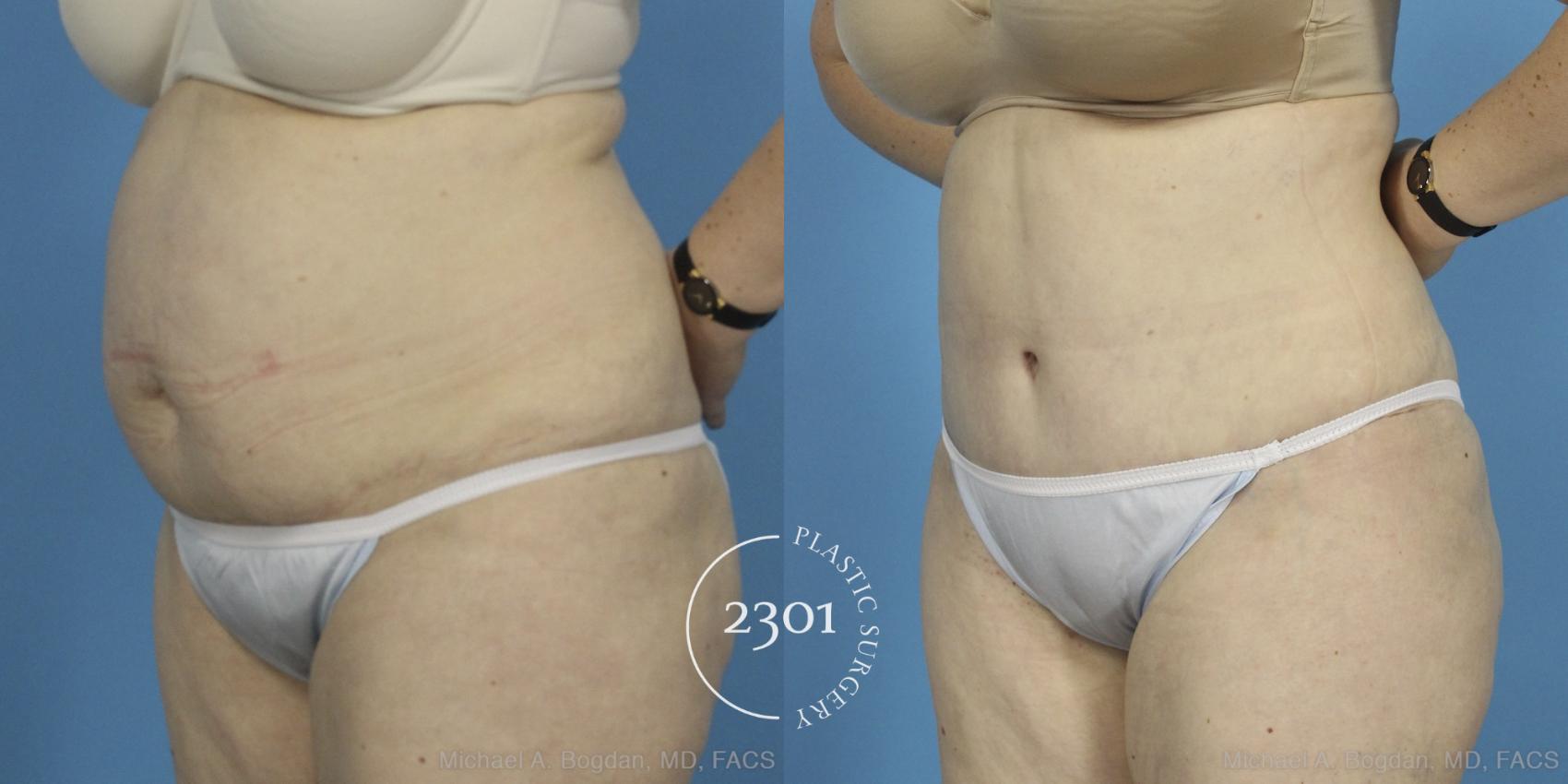 Before & After Liposuction Case 407 View #3 View in Fort Worth, Plano, & Frisco, Texas