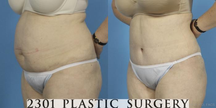 Before & After Tummy Tuck Case 407 View #3 View in Fort Worth, Plano, & Frisco, Texas