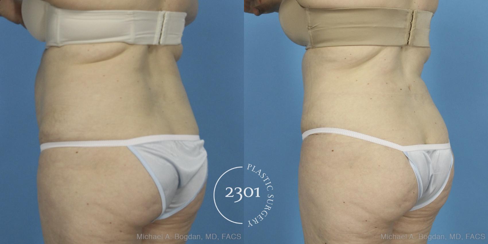 Before & After Liposuction Case 407 View #4 View in Fort Worth, Plano, & Frisco, Texas