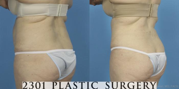 Before & After Tummy Tuck Case 407 View #4 View in Fort Worth, Plano, & Frisco, Texas