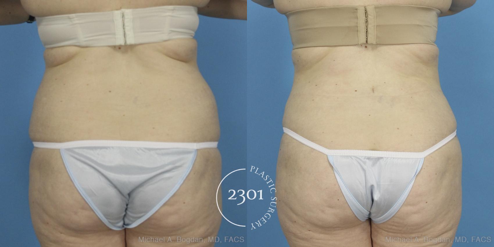 Before & After Liposuction Case 407 View #5 View in Fort Worth, Plano, & Frisco, Texas