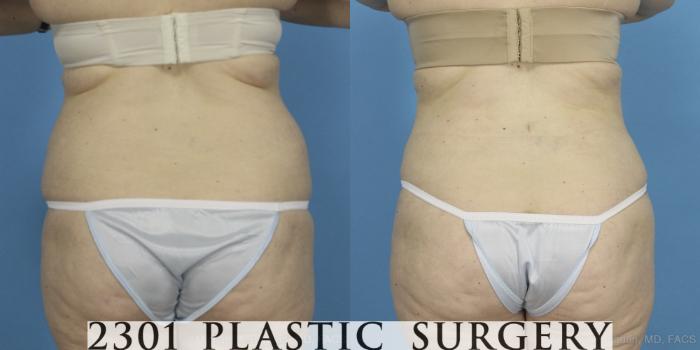 Before & After Tummy Tuck Case 407 View #5 View in Fort Worth, Plano, & Frisco, Texas