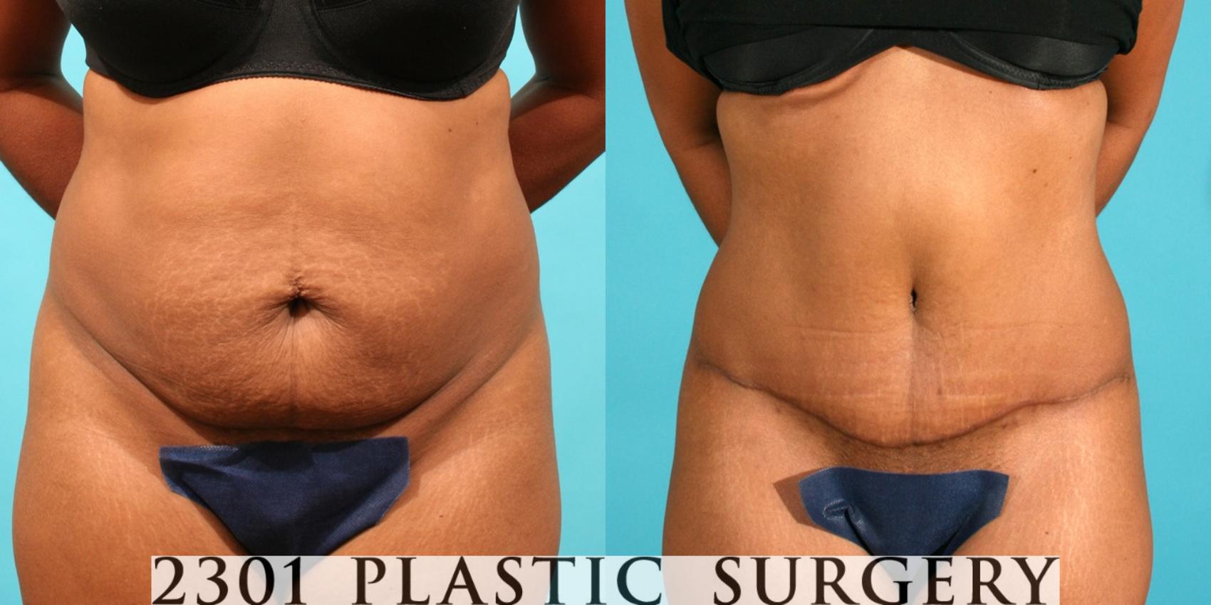 Before & After Tummy Tuck Case 41 View #1 View in Fort Worth, Plano, & Frisco, Texas