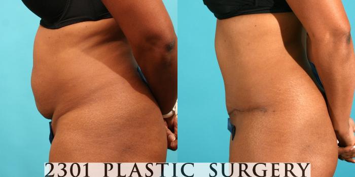 Before & After Tummy Tuck Case 41 View #2 View in Fort Worth, Plano, & Frisco, Texas