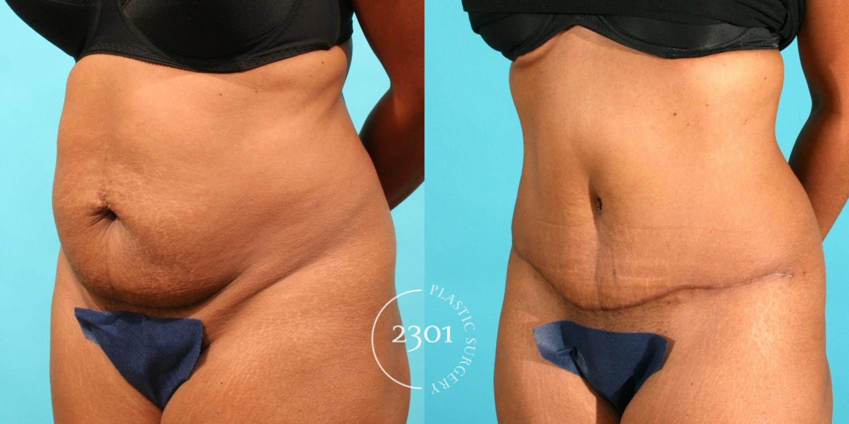 Before & After Tummy Tuck Case 41 View #3 View in Fort Worth, Plano, & Frisco, Texas