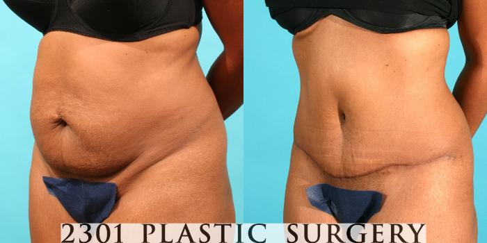 Before & After Tummy Tuck Case 41 View #3 View in Fort Worth, Plano, & Frisco, Texas