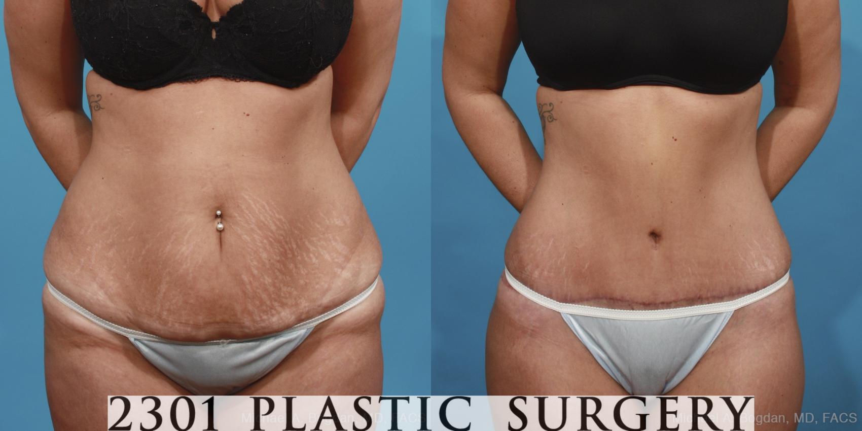 Before & After Tummy Tuck Case 421 View #1 View in Fort Worth & Frisco, Texas