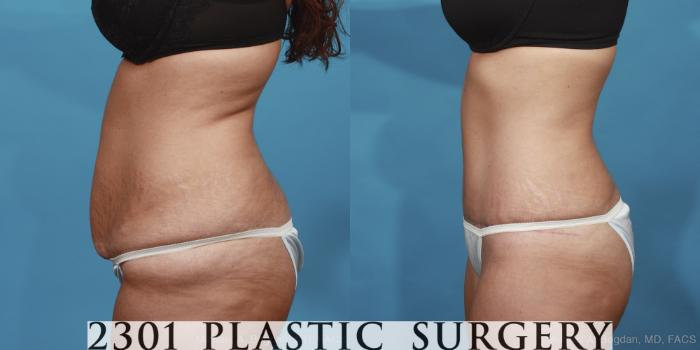 Before & After Tummy Tuck Case 421 View #2 View in Fort Worth, Plano, & Frisco, Texas