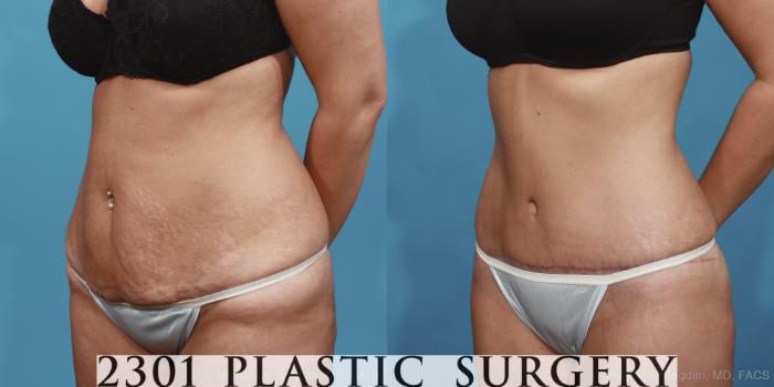 Before & After Tummy Tuck Case 421 View #3 View in Fort Worth, Plano, & Frisco, Texas