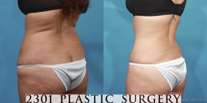 Before & After Tummy Tuck Case 421 View #4 View in Fort Worth, Plano, & Frisco, Texas