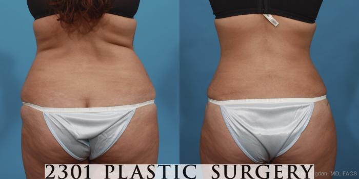 Before & After Tummy Tuck Case 421 View #5 View in Fort Worth, Plano, & Frisco, Texas