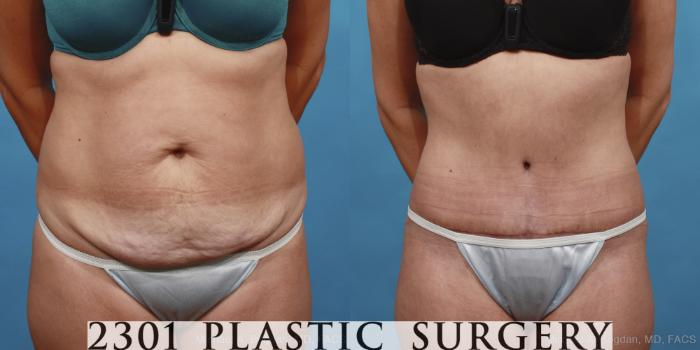 Before & After Tummy Tuck Case 433 View #1 View in Fort Worth, Plano, & Frisco, Texas