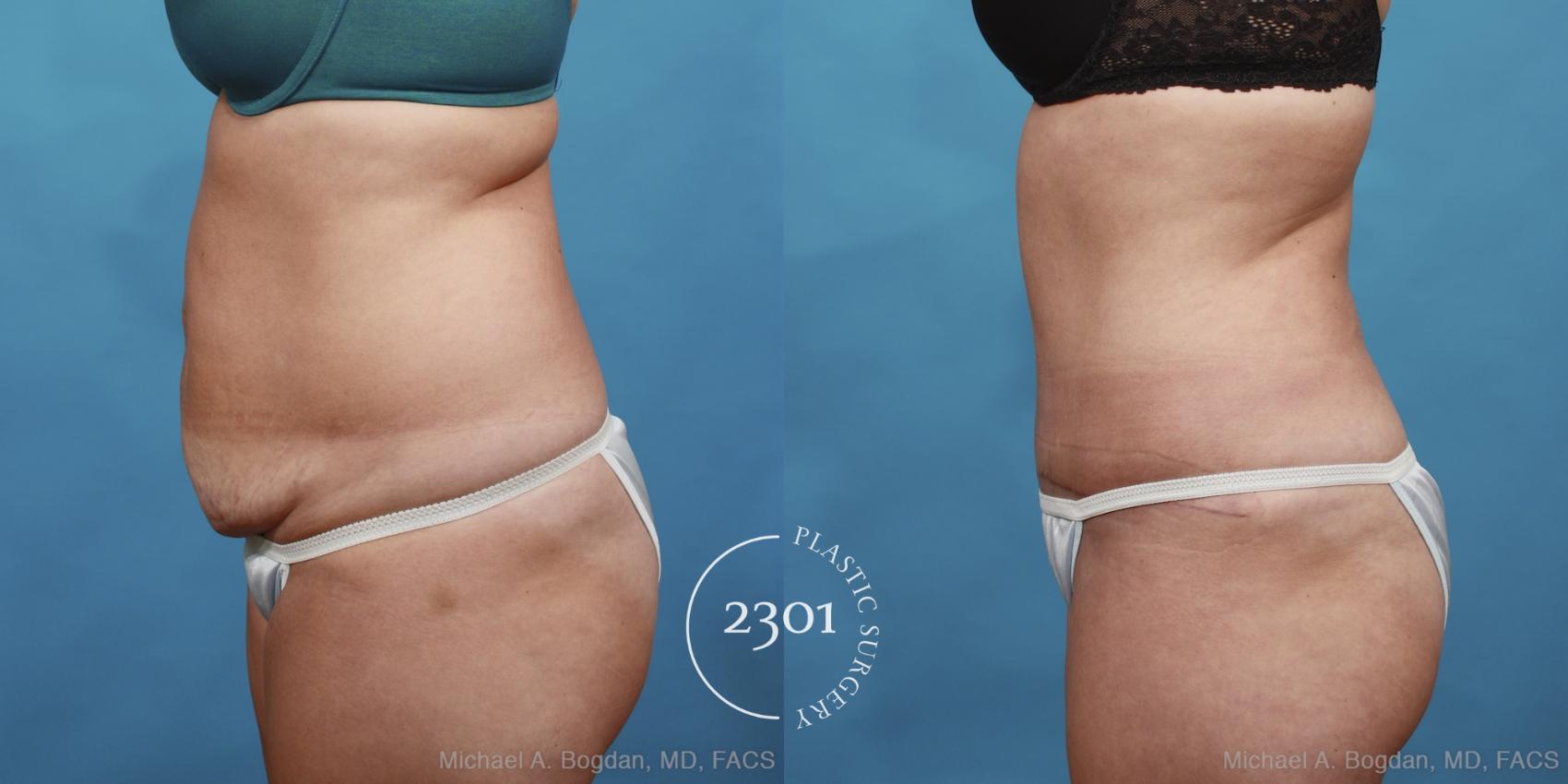 Before & After Tummy Tuck Case 433 View #2 View in Fort Worth, Plano, & Frisco, Texas