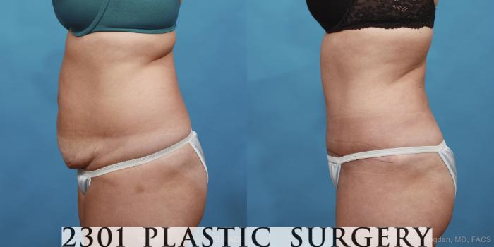 Before & After Tummy Tuck Case 433 View #2 View in Fort Worth, Plano, & Frisco, Texas
