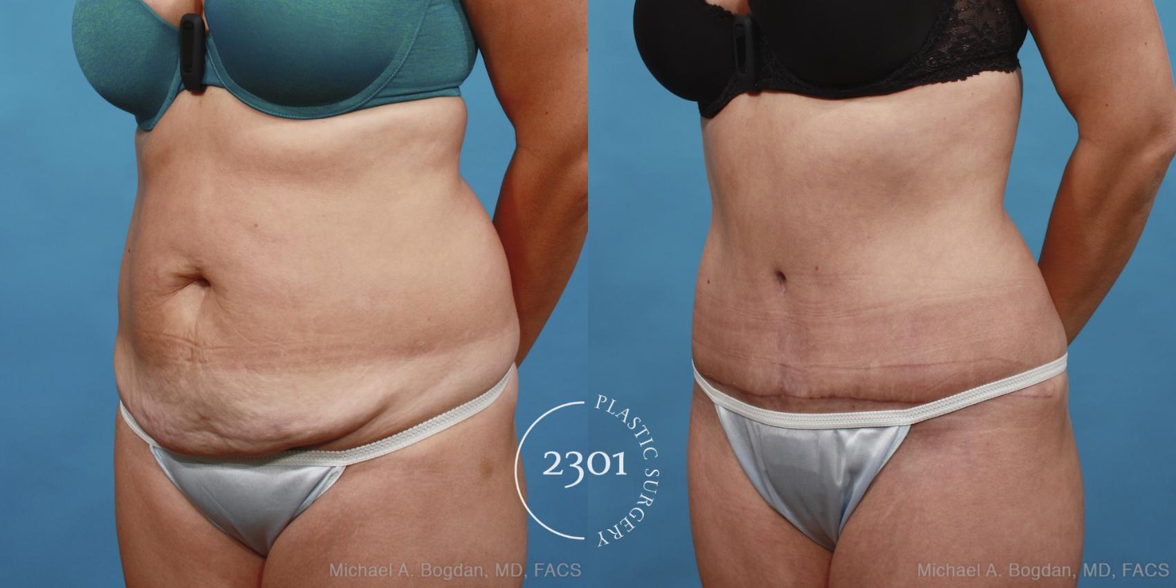 Before & After Tummy Tuck Case 433 View #3 View in Fort Worth, Plano, & Frisco, Texas