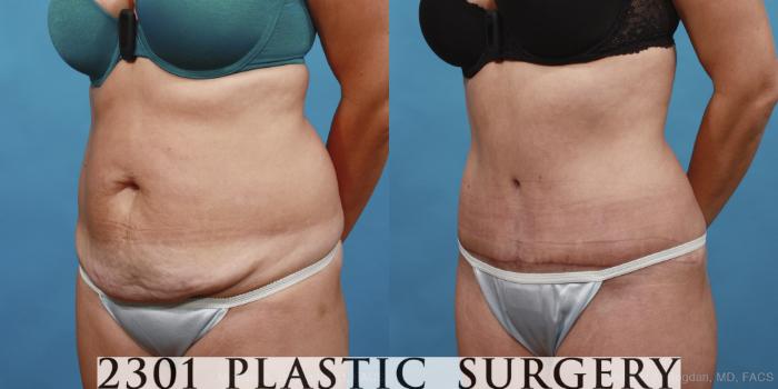 Before & After Tummy Tuck Case 433 View #3 View in Fort Worth, Plano, & Frisco, Texas