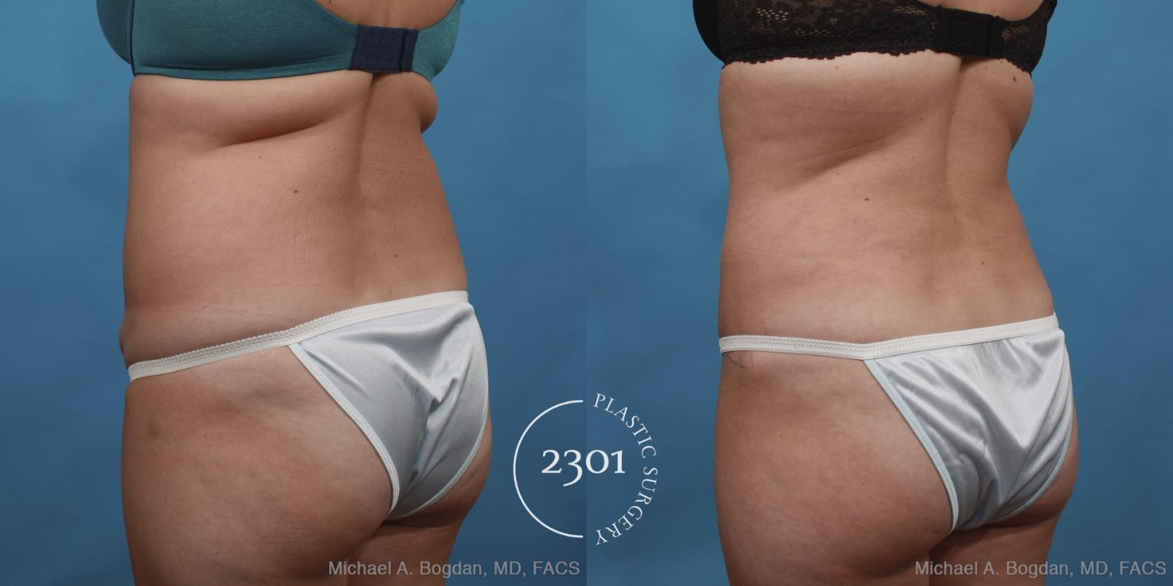 Before & After Tummy Tuck Case 433 View #4 View in Fort Worth, Plano, & Frisco, Texas