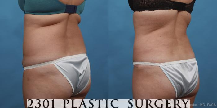 Before & After Tummy Tuck Case 433 View #4 View in Fort Worth, Plano, & Frisco, Texas