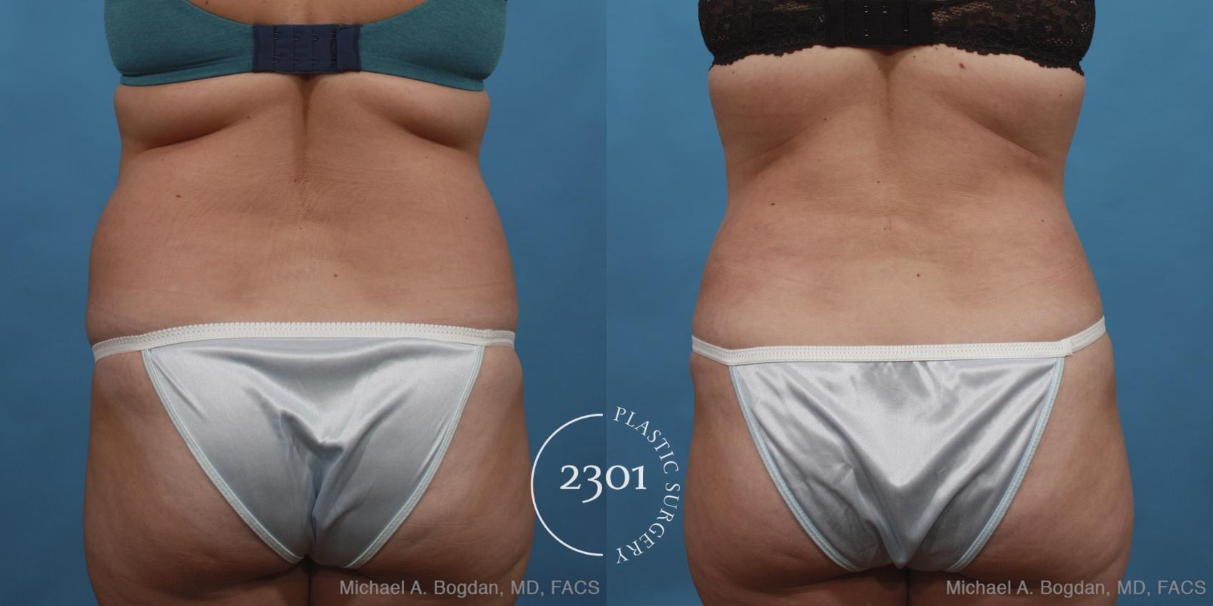 Before & After Tummy Tuck Case 433 View #5 View in Fort Worth, Plano, & Frisco, Texas